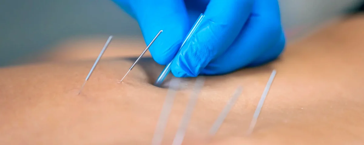 Acupuntura para el dolor en SJL