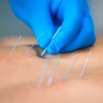 Acupuntura para el dolor en SJL