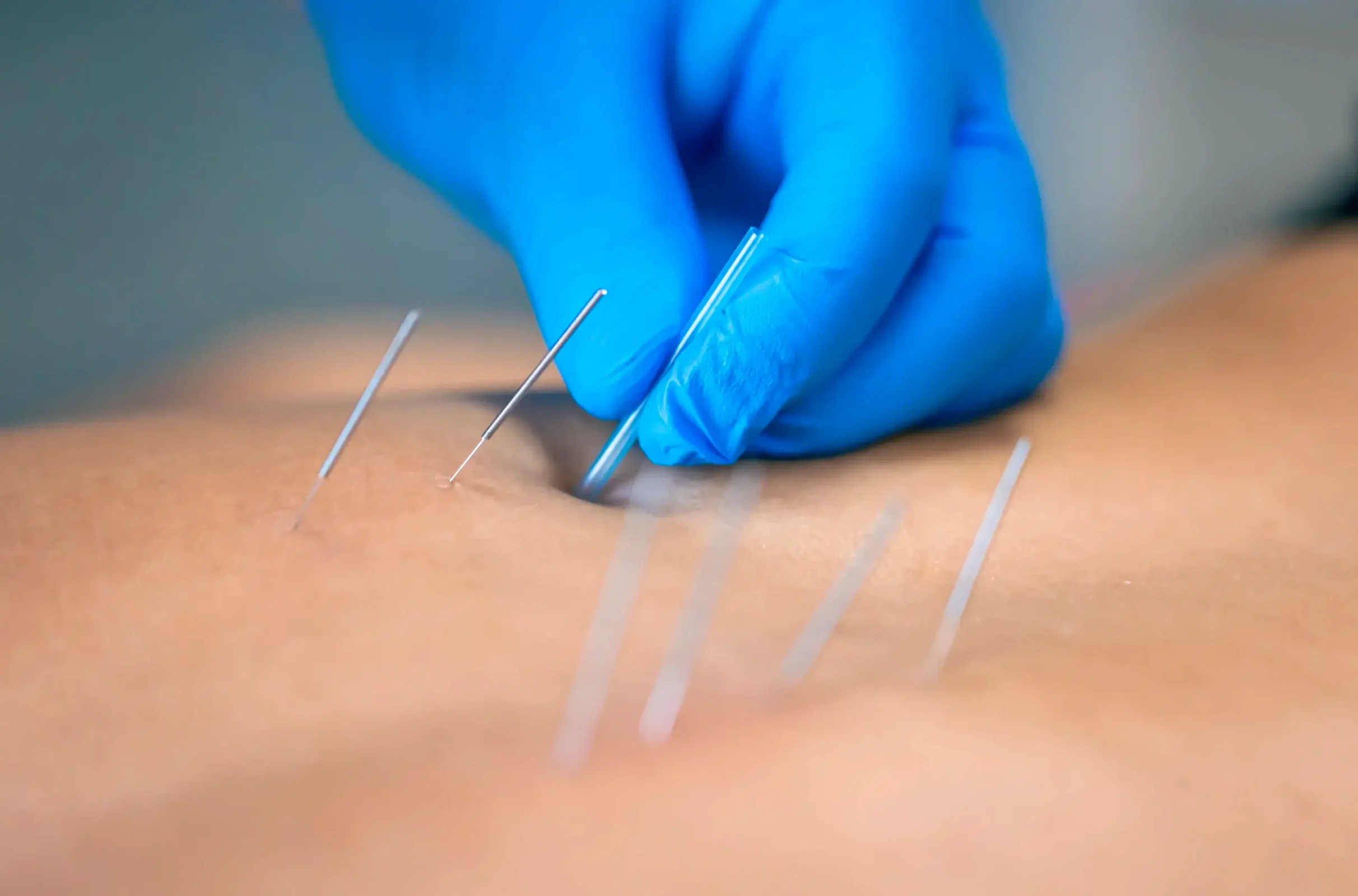 Acupuntura para el dolor en SJL