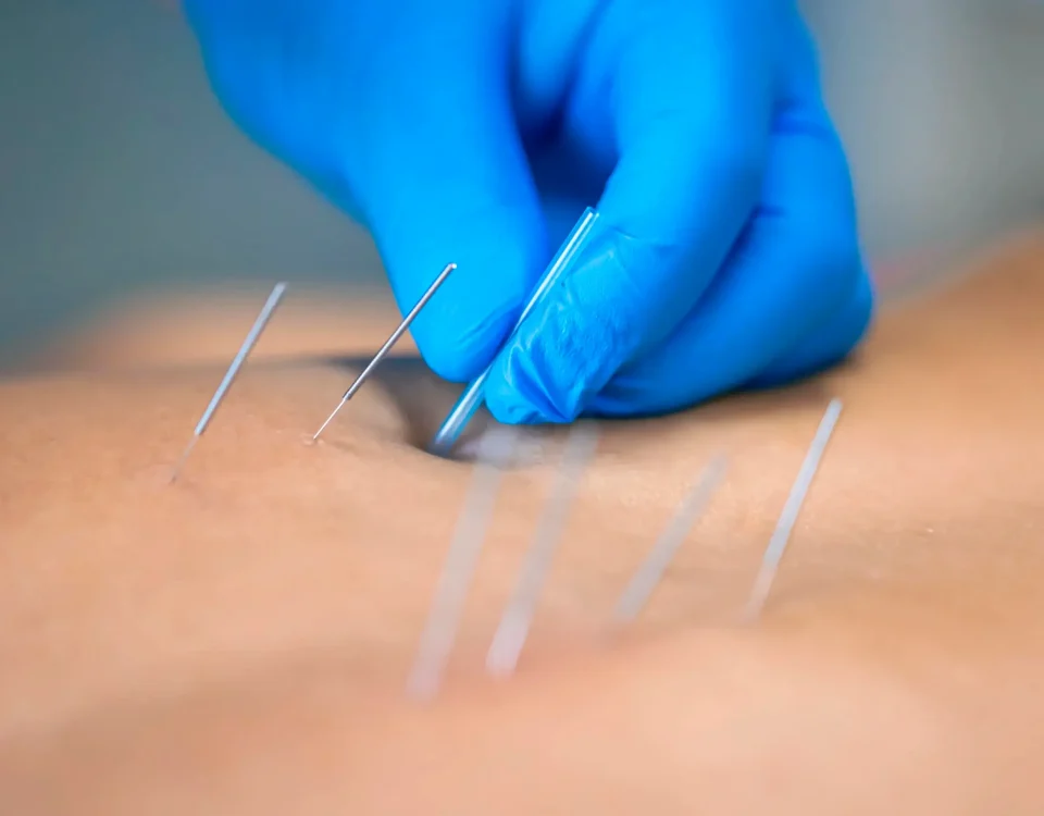 Acupuntura para el dolor en SJL