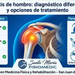 Bursitis de hombro: diagnóstico diferencial y opciones de tratamiento