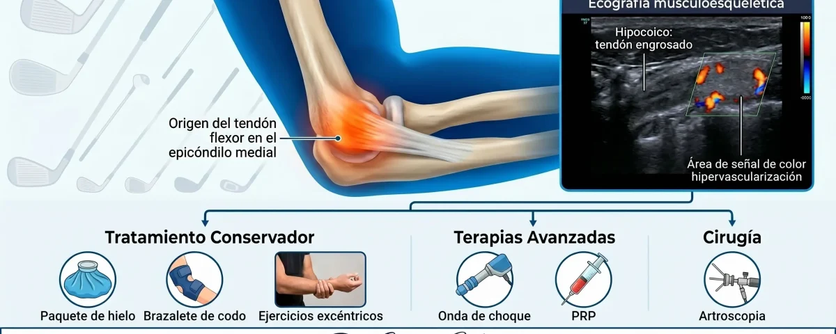 Epicondilitis medial (codo de golfista): diagnóstico y plan de tratamiento