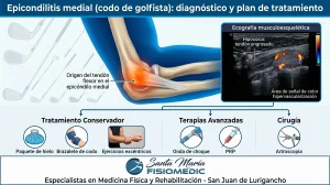 Epicondilitis medial (codo de golfista): diagnóstico y plan de tratamiento