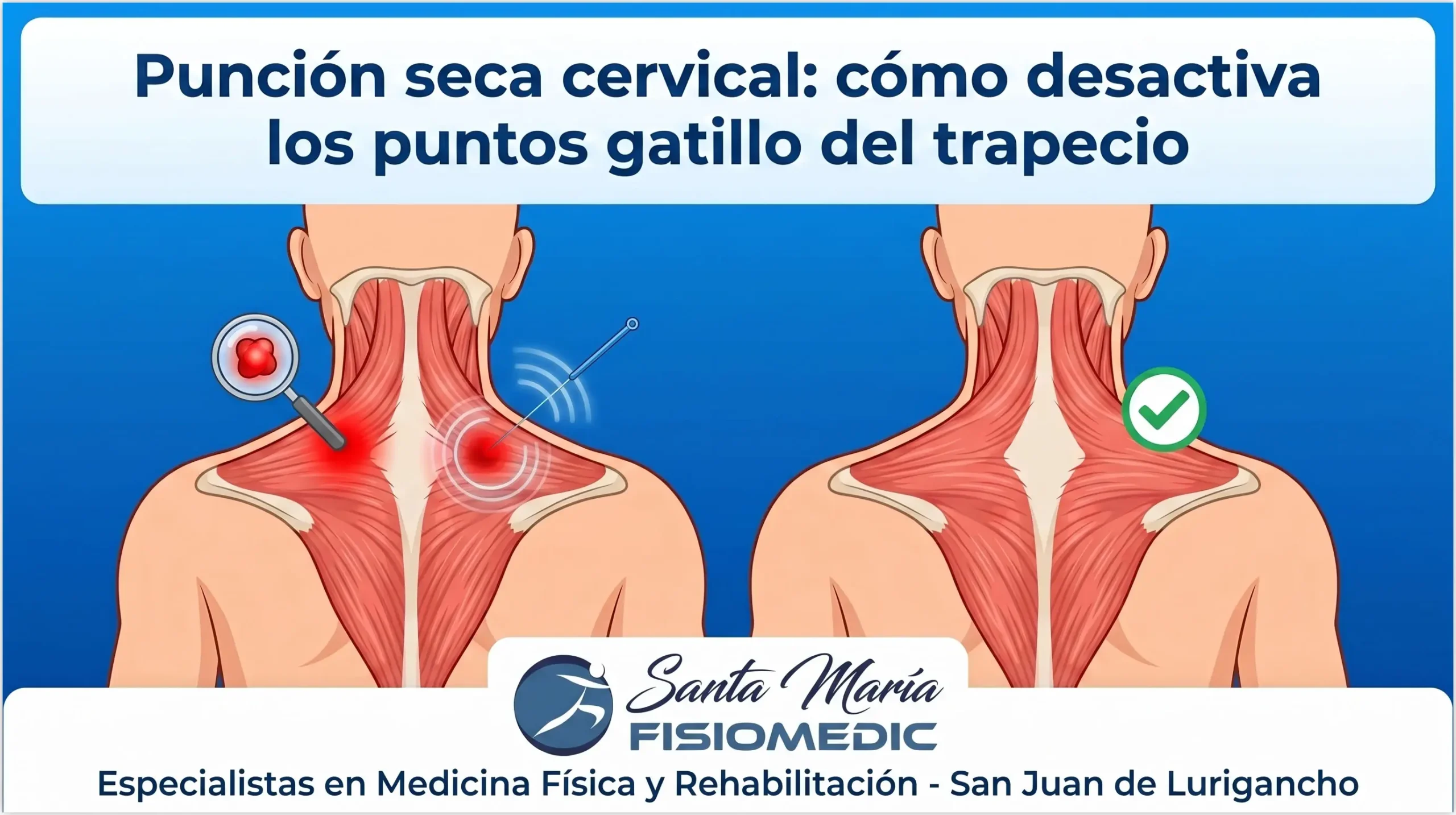 Punción seca cervical: cómo desactiva los puntos gatillo del trapecio