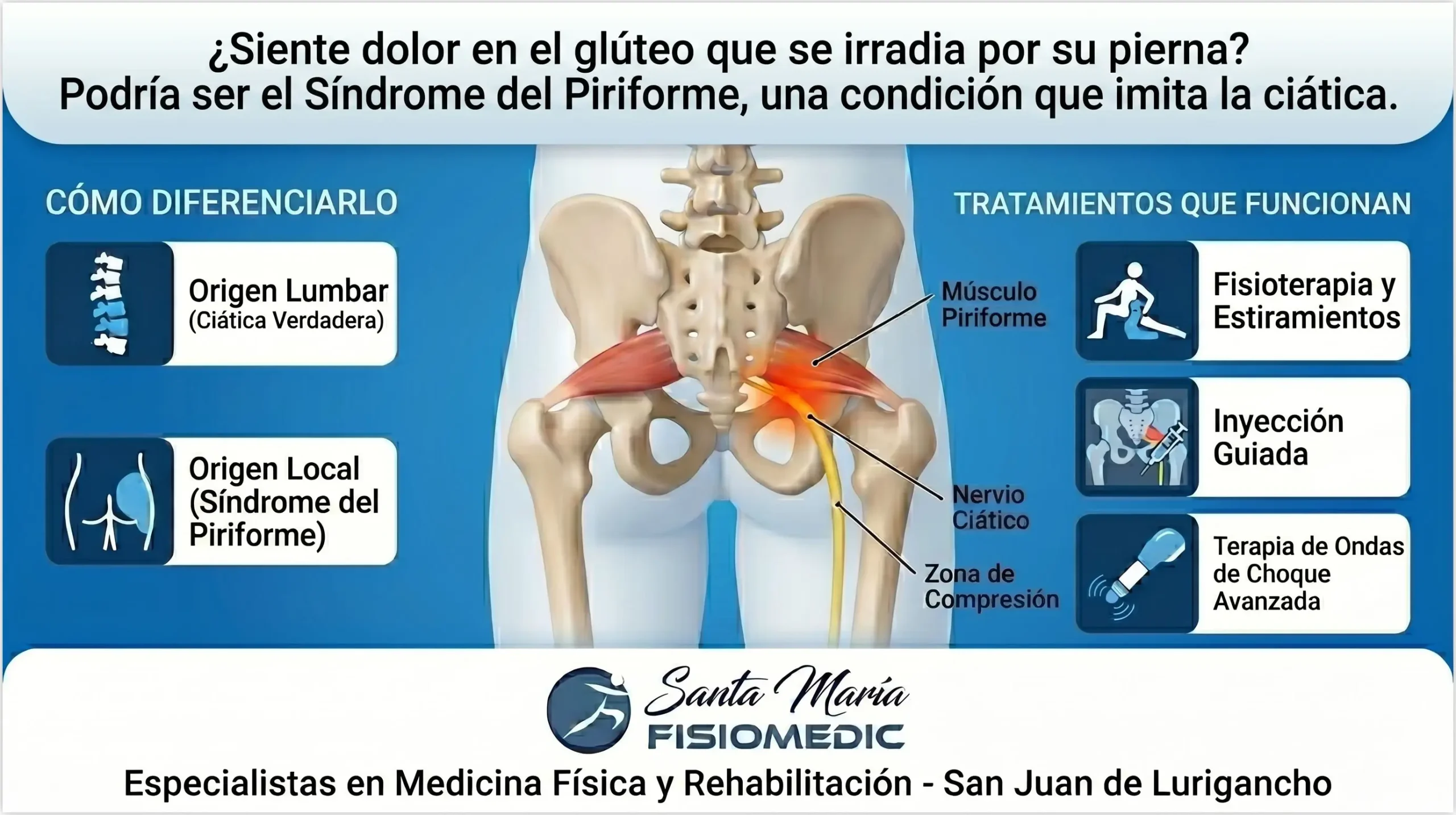 Síndrome del piriforme: el dolor de cadera que se confunde con ciática
