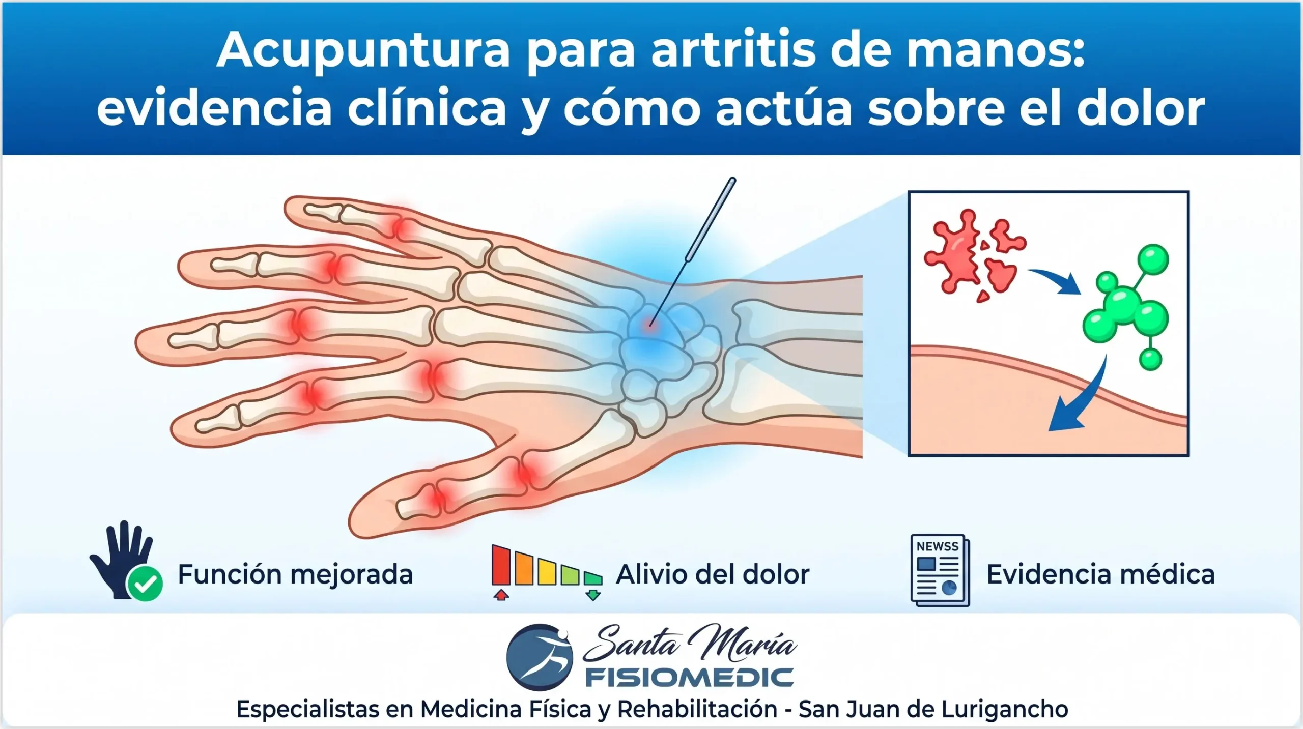 Acupuntura para artritis de manos: evidencia clínica y cómo actúa sobre el dolor