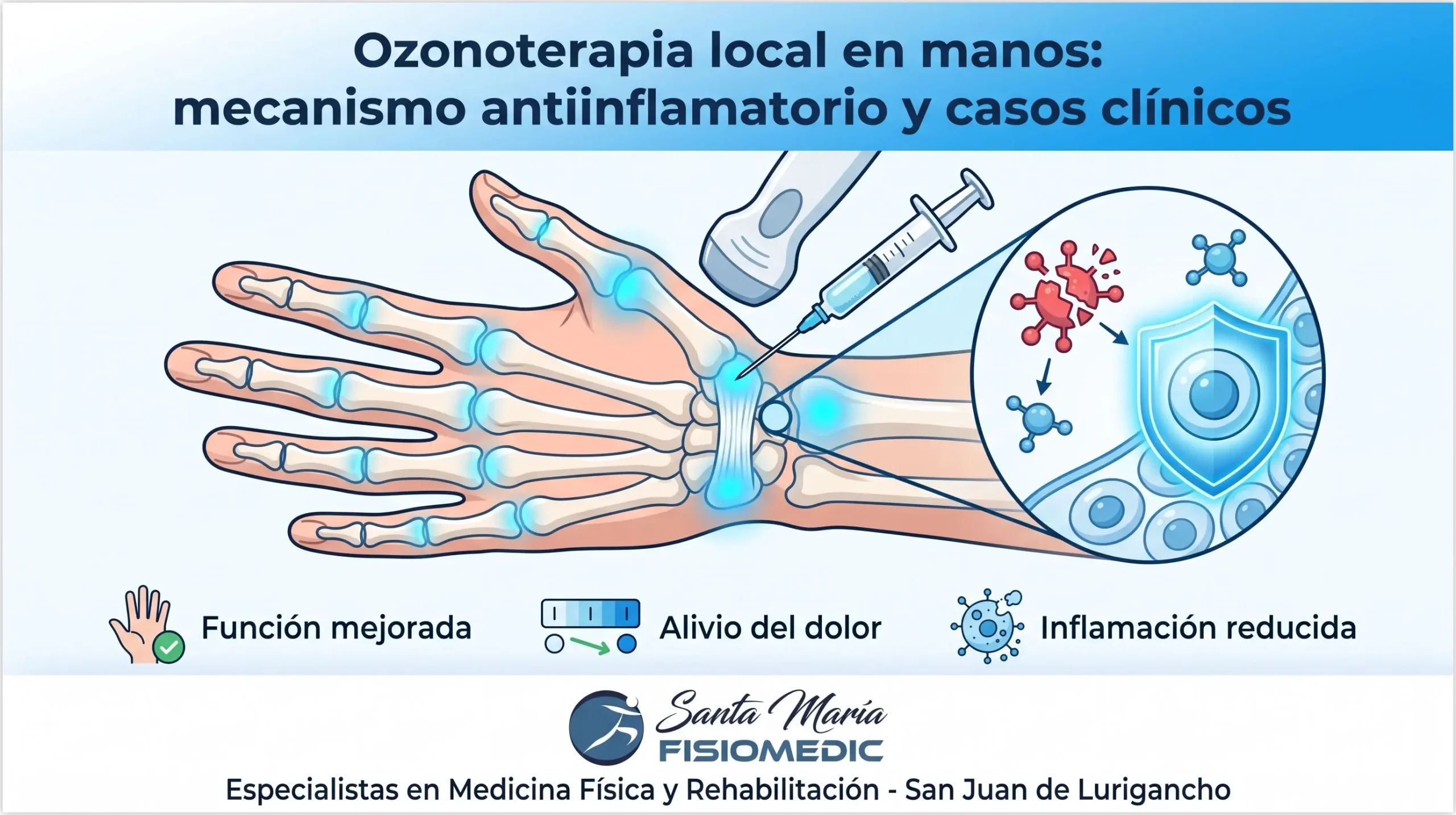Ozonoterapia local en manos: mecanismo antiinflamatorio y casos clínicos