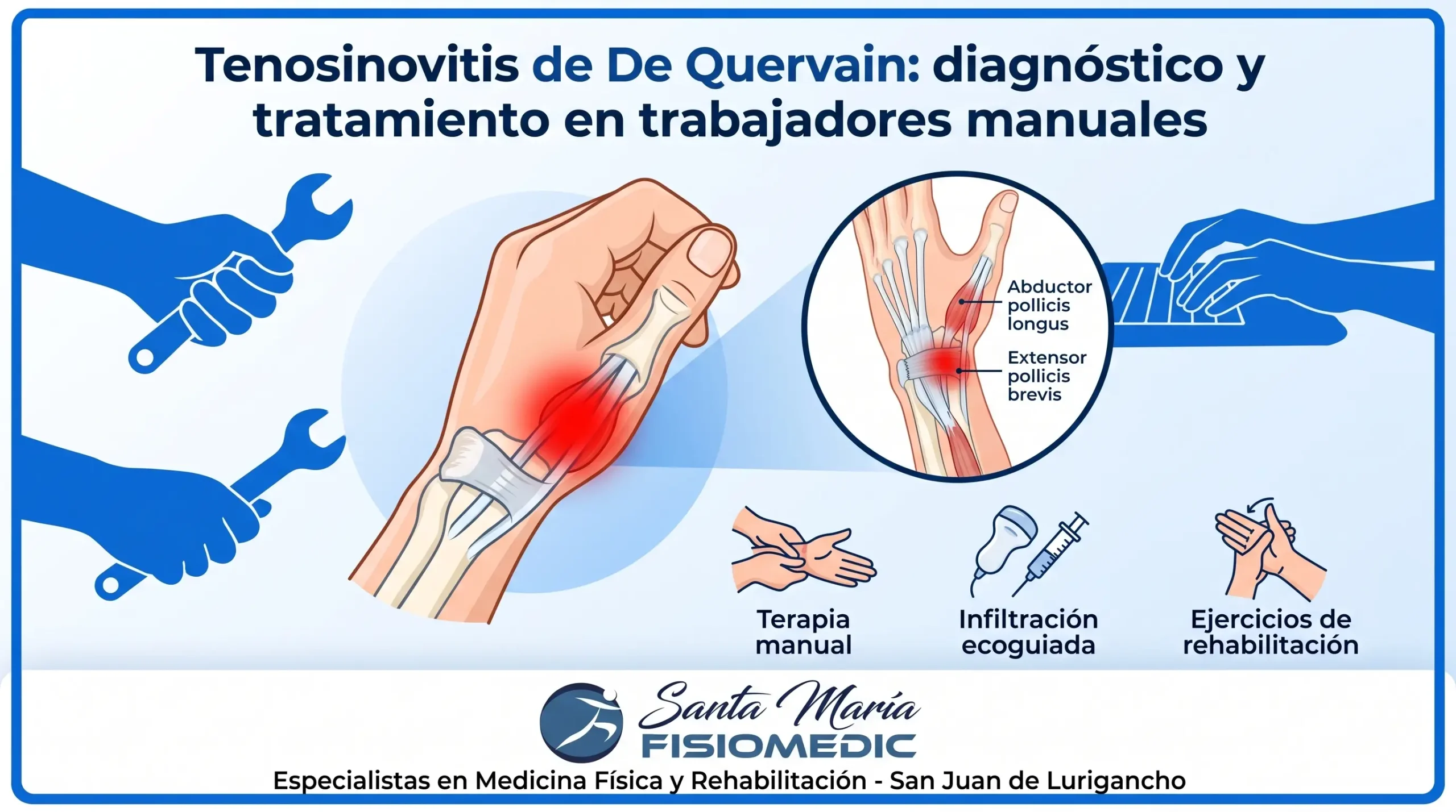 Tenosinovitis de De Quervain: diagnóstico y tratamiento en trabajadores manuales