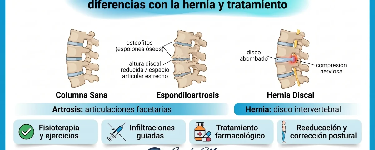 Artrosis de columna (espondiloartrosis): diferencias con la hernia y tratamiento