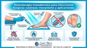 Ozonoterapia transdérmica para infecciones fúngicas cutáneas: mecanismo y aplicaciones