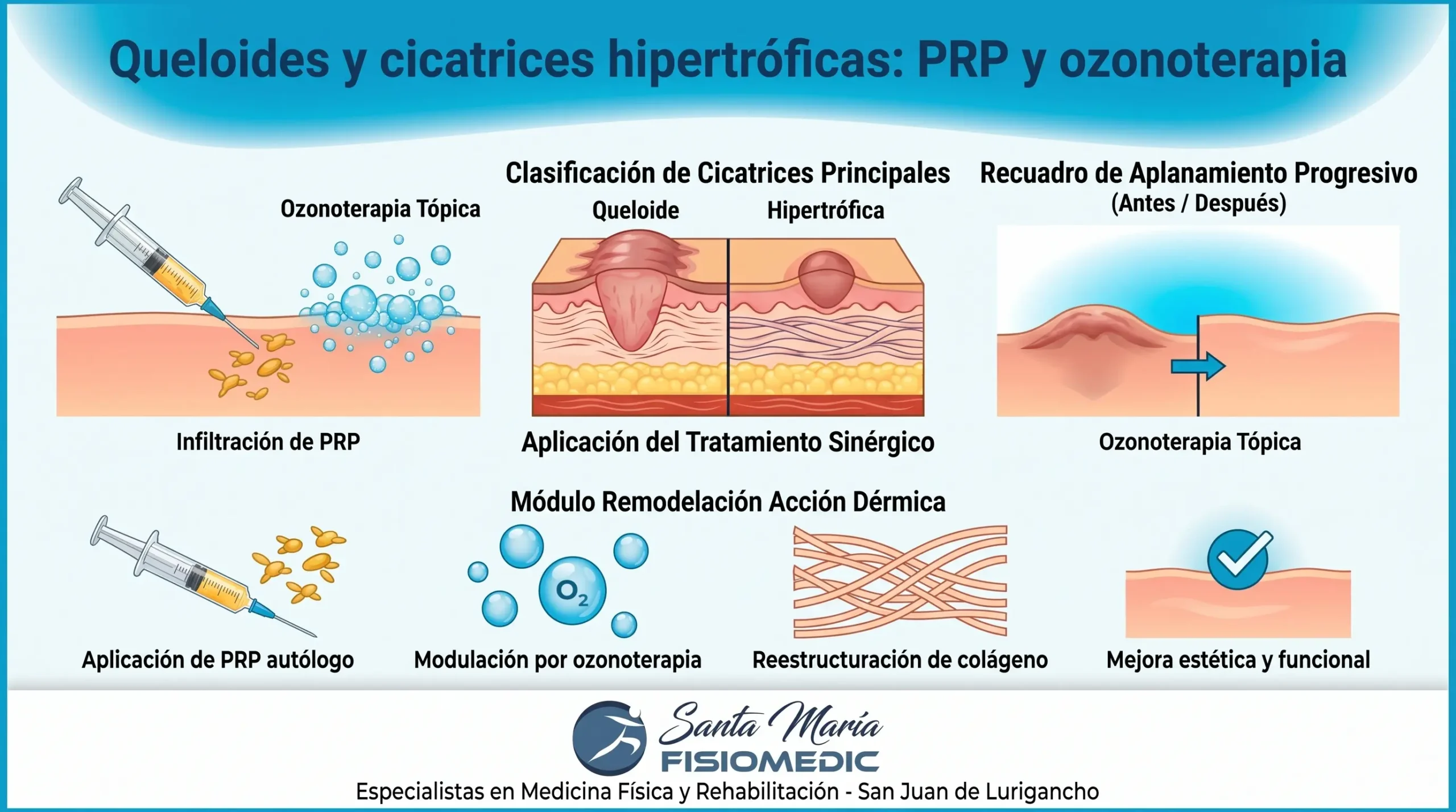Queloides y cicatrices hipertróficas: PRP y ozonoterapia